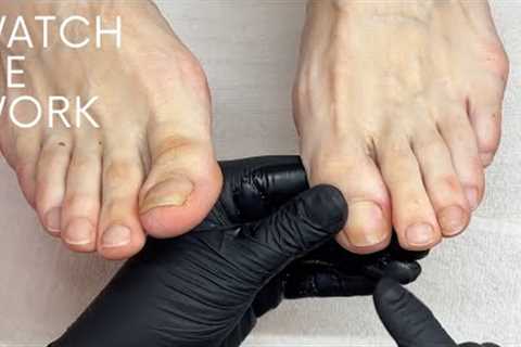 Pedicuring toenails with micro trauma damage (follow up #3)
