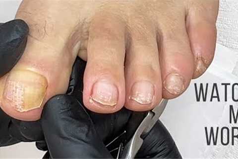 Pedicuring toes with nail surface damage and onycholisys due to micro trauma.