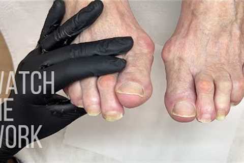 Cutting and maintaining THICK toenails.