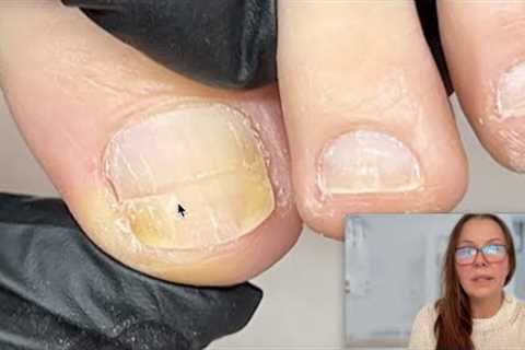 Cutting out a damaged toenail [Watch Me Work]