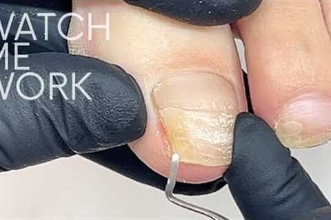 Fixing a very badly cracked toenail with gel  [Pedicure Part 1]
