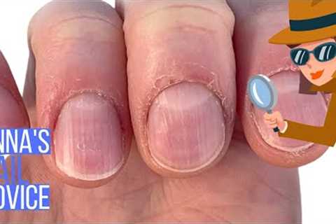 Overcoming nail bitting and picking for an upcoming wedding [Anna's Nail Advice]