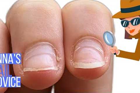 Extra nail layer growing on the nail? [Anna's Nail Advice]
