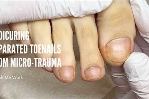Pedicuring separated toenails due to micro trauma