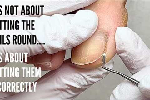 Do not cut your nails like this to avoid painful corners.