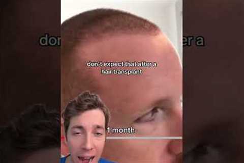 The Hair Transplant Timeline: What to Expect