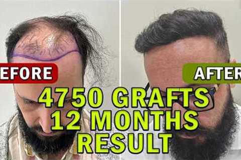 Hair Transplant Time Lapse 4750 Grafts 12 Months  FULL Journey l Hair Transplant Before &amp; After