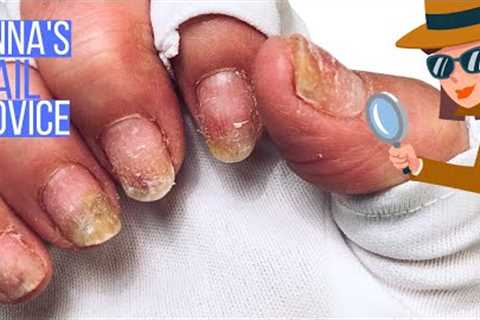 Painful, raised nails after gel polish [Anna's Nail Advice]