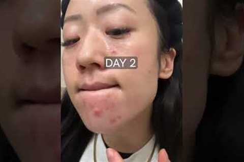 😲 GAMECHANGING combination to getting rid of cystic acne breakouts fast! #shorts