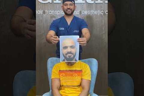 Before and After: The Incredible Sapphire FUE Hair Transplant Journey at CARA