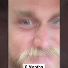 MONTH BY MONTH HAIR TRANSPLANT RESULT - BEFORE AND AFTER