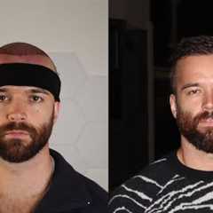 My 6 Month Hair Transplant Update