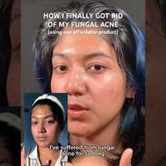 One product that helped me clear my fungal acne!! | #skincare #skincaretips #acnetreatment