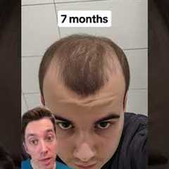 Calling BS on “Just Minoxidil”?
