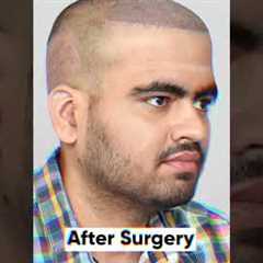 Nine Months Hair Transplant Result | Latest Fue Technique #shorts #viral #hair transplant