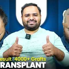 Grade 7 Baldness Hair Transplant in Pune | Amazing Hair Transplant Results & Cost in Pune
