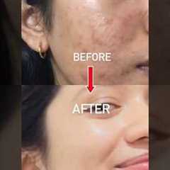 1 PRODUCT Changed ACNE TO CLEAR SKIN JOURNEY🤍🥺With in 2 month#acne
