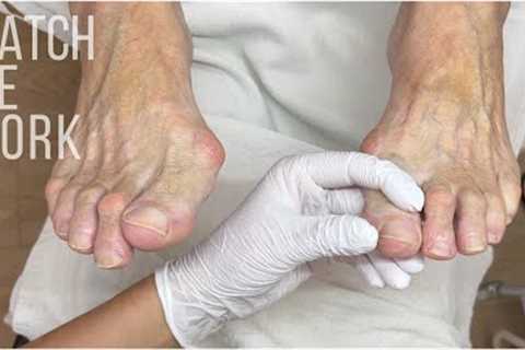 Gentle, professional care for mature feet, thickened toenails and dry skin vs. callus