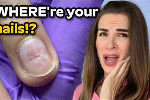 She ripped off her nail extensions...