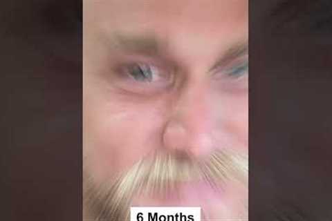 MONTH BY MONTH HAIR TRANSPLANT RESULT - BEFORE AND AFTER