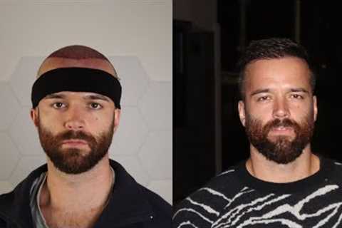 My 6 Month Hair Transplant Update