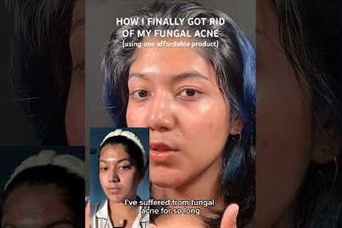 One product that helped me clear my fungal acne!! | #skincare #skincaretips #acnetreatment
