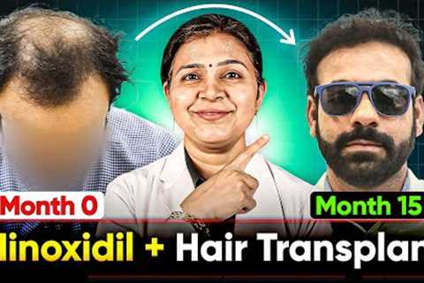 Minoxidil + Hair Growth Time Lapse | Best Hair Transplant Results in India | Hair Growth