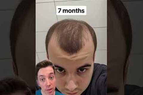 Calling BS on “Just Minoxidil”?