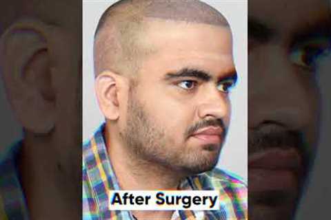 Nine Months Hair Transplant Result | Latest Fue Technique #shorts #viral #hair transplant
