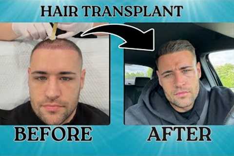 My Second Hair Transplant | 5 month Update