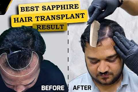 Best Sapphire FUE Hair Transplant Results (Time Lapse) Dr.Pranil More