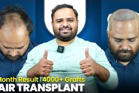 Grade 7 Baldness Hair Transplant in Pune | Amazing Hair Transplant Results &amp; Cost in Pune
