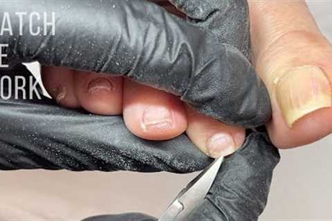 Pedicuring curved (involuted) toenails.