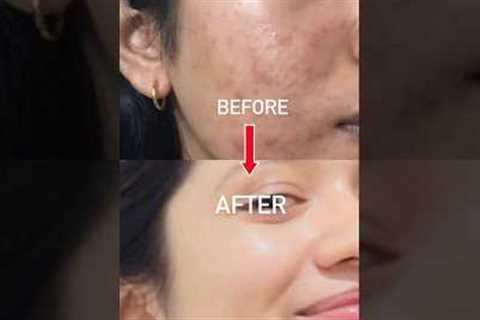 1 PRODUCT Changed ACNE TO CLEAR SKIN JOURNEY🤍🥺With in 2 month#acne