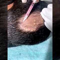 Alopecia Areata Treatment For Hair Growth | Treatment Of Alopecia | Skinaa Clinic #shorts #viral
