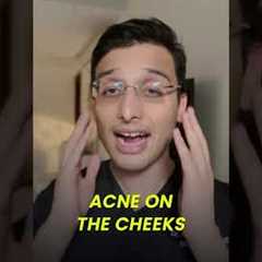 Getting acne on specific areas of the face?? || Dr Ankur Sarin ||