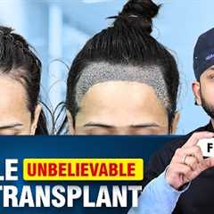 Female Hair Transplant Surgery Explained by Dr. Ankit Jain at Hairfree & Hairgrow Clinic