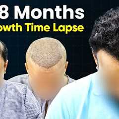 Hair Transplant Time Lapse - Hair Transplant Before & After | Hair Transplant Results and Hair..