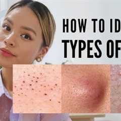 How to treat EVERY type of acne (With Pictures )