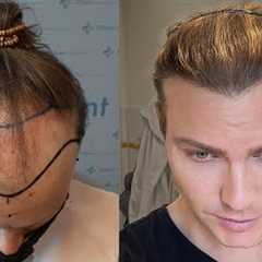Hair Transplant in Timelapse - Before After Result