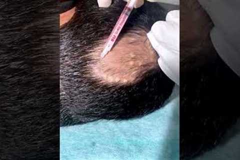 Alopecia Areata Treatment For Hair Growth | Treatment Of Alopecia | Skinaa Clinic #shorts #viral