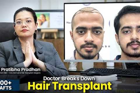 Case Study: Impressive Hair Transplant by Dr. Pratibha Pradhan #hairtransplant