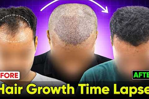 Hair Growth Time Lapse - 5 Months Hair Transplant Before &amp; After | Hair Transplant Results #hair