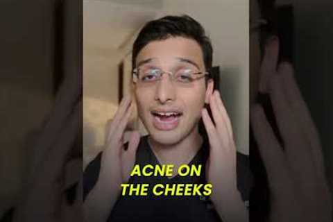 Getting acne on specific areas of the face?? || Dr Ankur Sarin ||