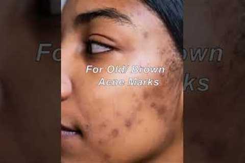Pharmacy creams for acne marks (more details on  description box ) #facedecor #skincare #shorts