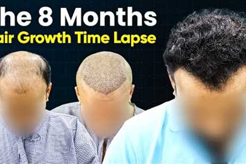 Hair Transplant Time Lapse - Hair Transplant Before &amp; After | Hair Transplant Results and Hair..