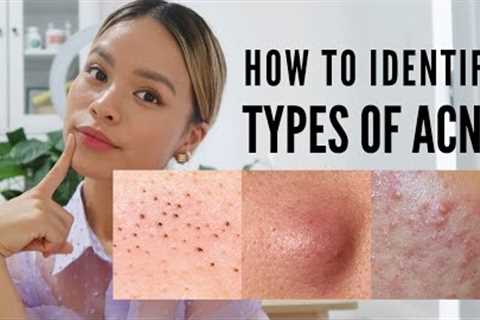 How to treat EVERY type of acne (With Pictures )