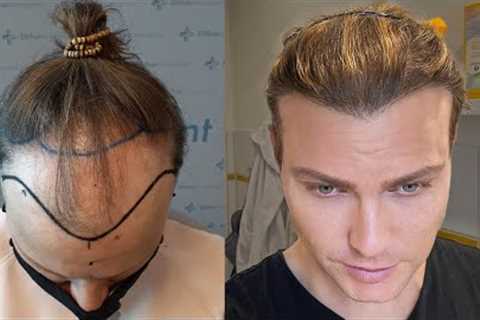 Hair Transplant in Timelapse - Before After Result