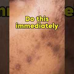 2 steps to reduce acne scars