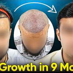 Hair Growth Results (9 Months Before and After) | Hair Transplant Time Lapse and Cost Details #hair